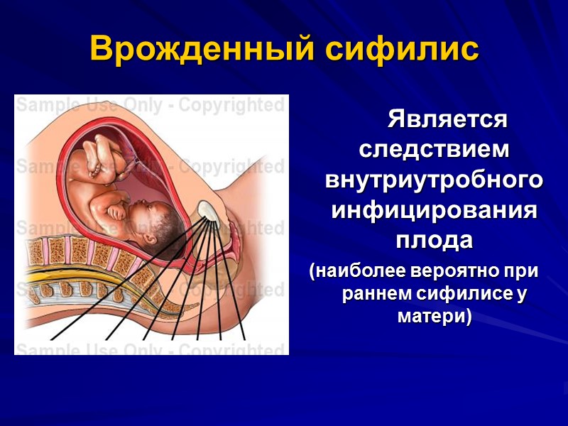 Врожденный сифилис        Является следствием внутриутробного инфицирования плода